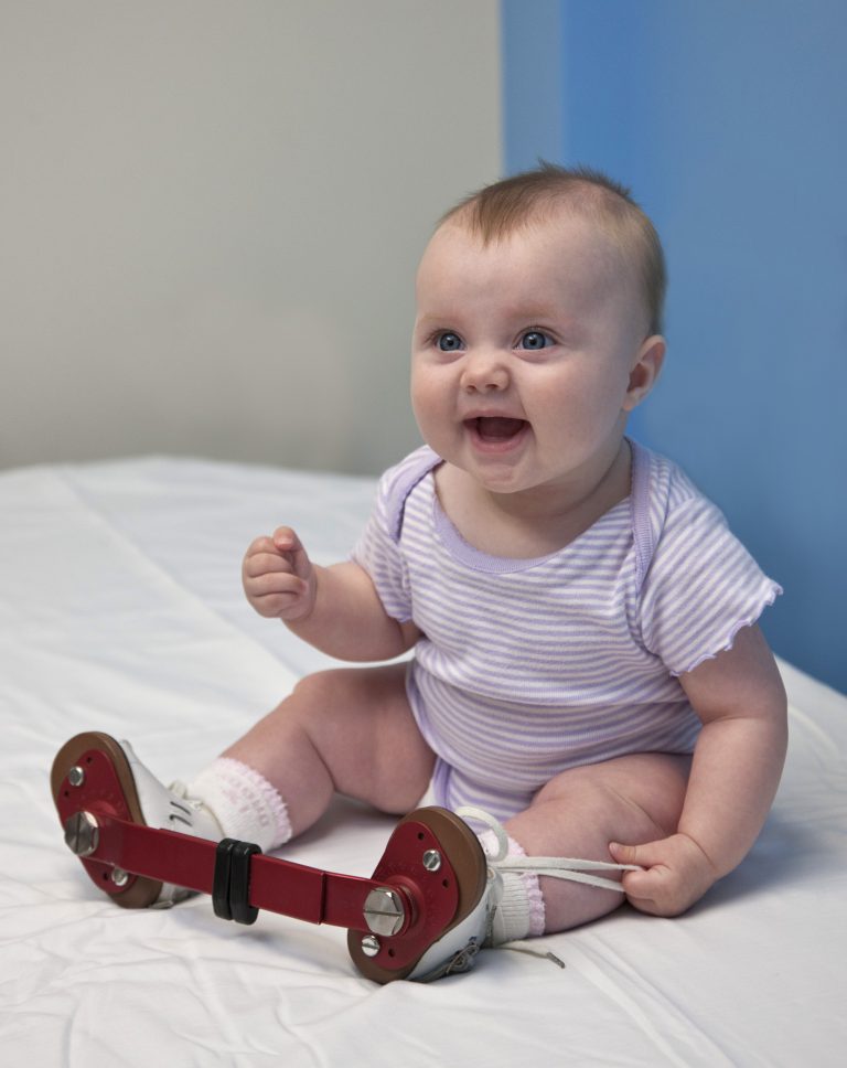 Clubfoot (Talipes Equinovarus) - Campbell Clinic Orthopaedics