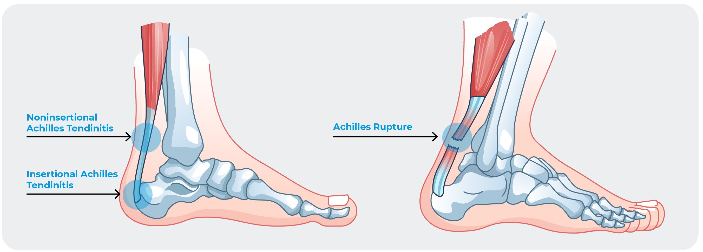 https://www.campbellclinic.com/wp-content/uploads/2023/05/Achilles-Injuries.png