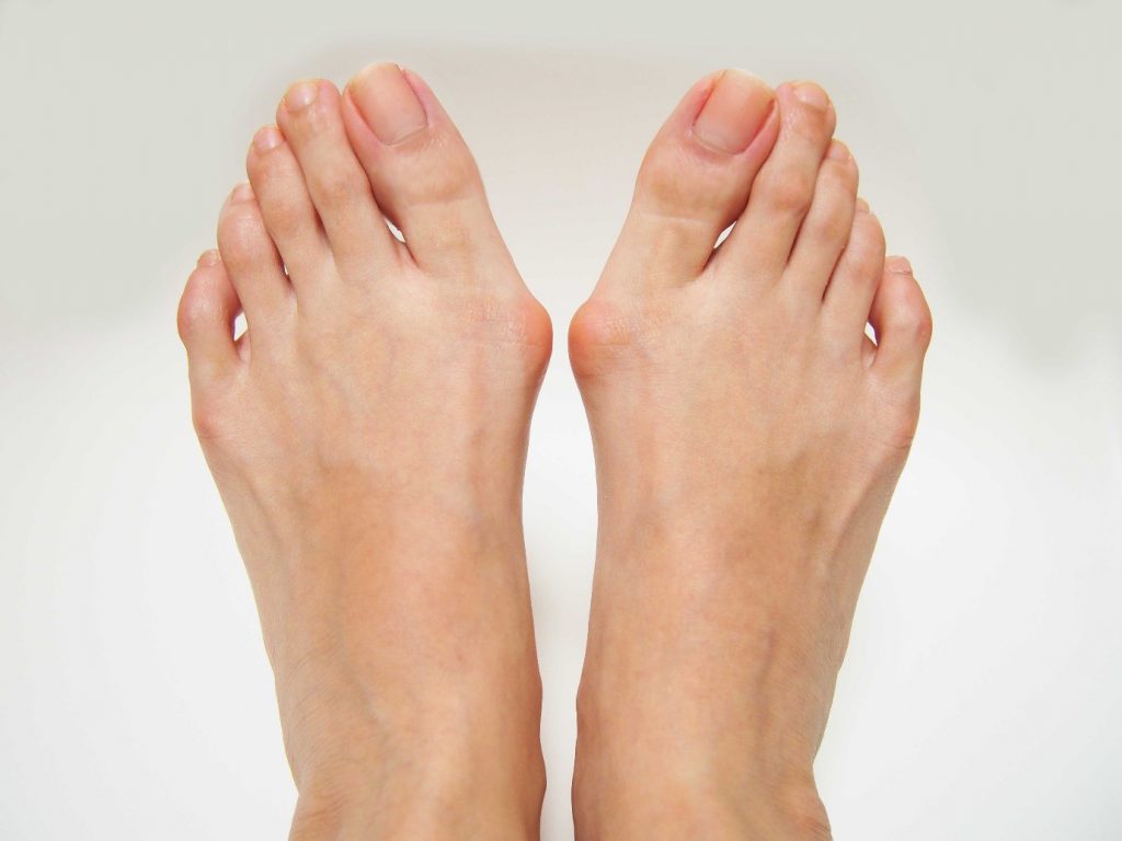 Top profile of feet with bunions