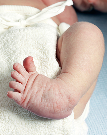Close up of a baby with a curved, clubfoot