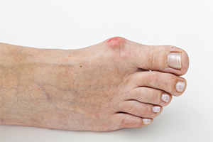 top profile of a foot with bunions