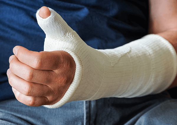 A broken hand in a cast