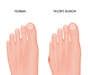 A normal foot next to one with a Tailor's Bunion